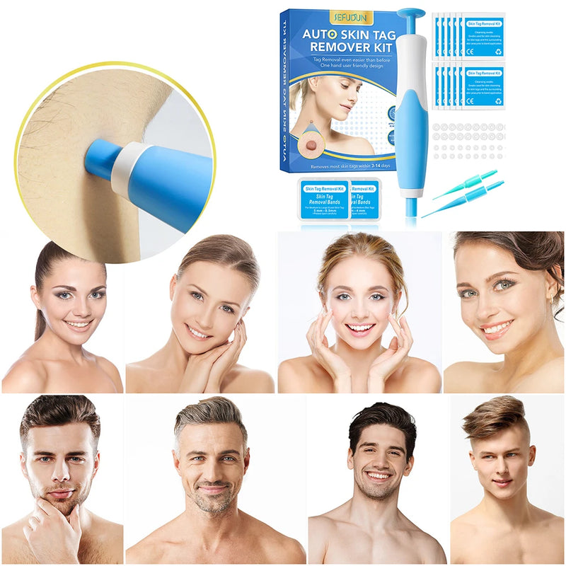 Rubber Rings Skin Tag Removal Tool Face Beauty Accessories Skin Tag Removal