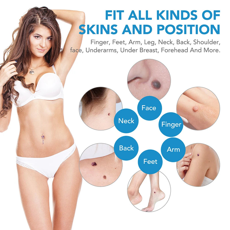 Rubber Rings Skin Tag Removal Tool Face Beauty Accessories Skin Tag Removal