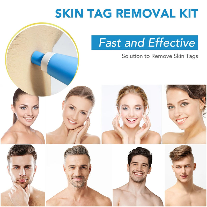 Rubber Rings Skin Tag Removal Tool Face Beauty Accessories Skin Tag Removal