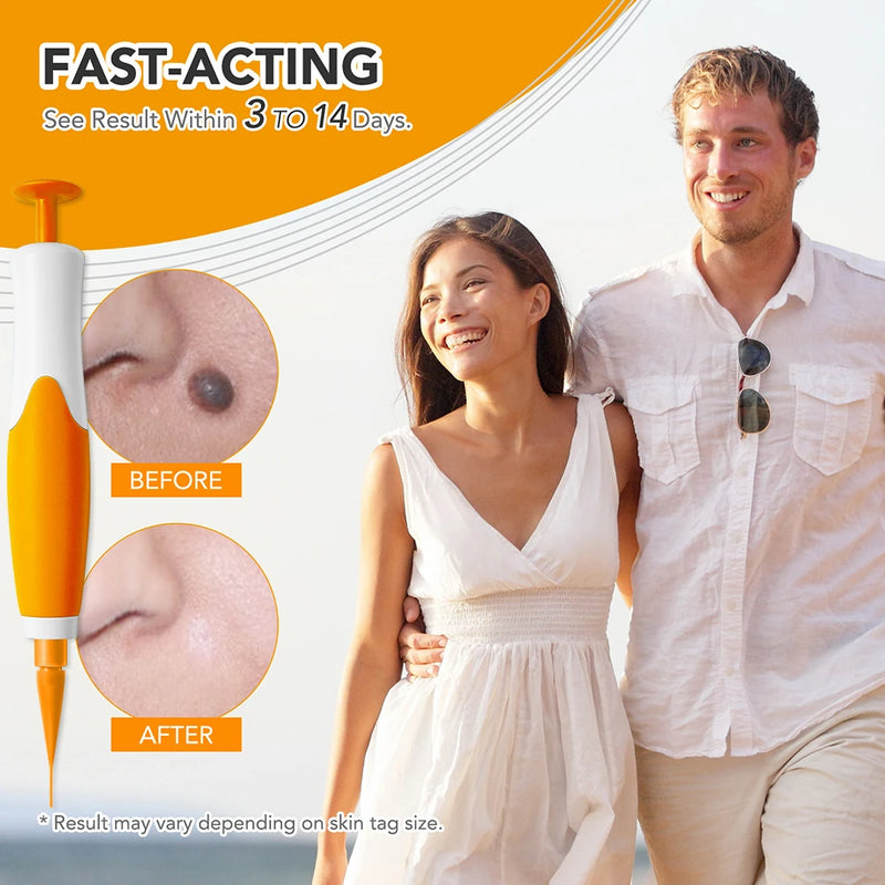 Rubber Rings Skin Tag Removal Tool Face Beauty Accessories Skin Tag Removal
