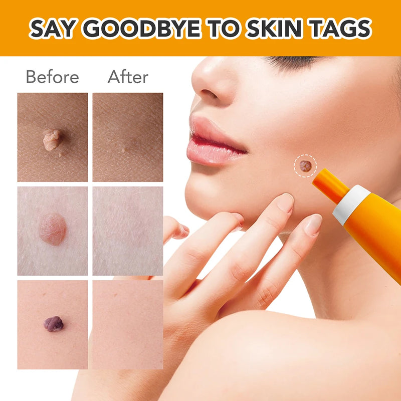 Rubber Rings Skin Tag Removal Tool Face Beauty Accessories Skin Tag Removal